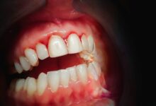 Photo of Liver Disease -ब्रश करते समय कहीं आपके दांतों से भी तो नहीं आ रहा खून खतरनाक बीमारी के हैं लक्षण