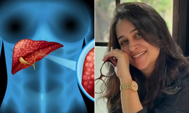 Deepika Kakkar Stage-2 liver Cancer: How dangerous is stage-2 liver cancer? Can life be saved? Know important things related to Deepika Kakkar's condition
