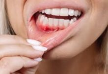 Relief from mouth ulcers: Troubled by mouth ulcers? These 5 home remedies will provide instant relief.