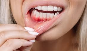 Relief from mouth ulcers: Troubled by mouth ulcers? These 5 home remedies will provide instant relief.