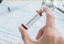 टीबी भारत रिपोर्ट, RTI टीबी खुलासा, TB cases India 2025, National TB Elimination Programme, तपेदिक मरीज आंकड़े, TB in Uttar Pradesh, India health mission failure,  टीबी उन्मूलन लक्ष्य, TB rise in India, NTEP India data