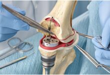 IAS-JOPP Lucknow 2026, Knee Preservation, घुटना बचाने की सर्जरी, Knee Preservation Surgery, Indian Arthroscopy Society, Lucknow Orthopaedic Society, घुटने की सर्जरी, Knee Replacement