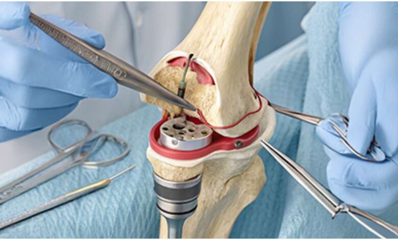 IAS-JOPP Lucknow 2026, Knee Preservation, घुटना बचाने की सर्जरी, Knee Preservation Surgery, Indian Arthroscopy Society, Lucknow Orthopaedic Society, घुटने की सर्जरी, Knee Replacement
